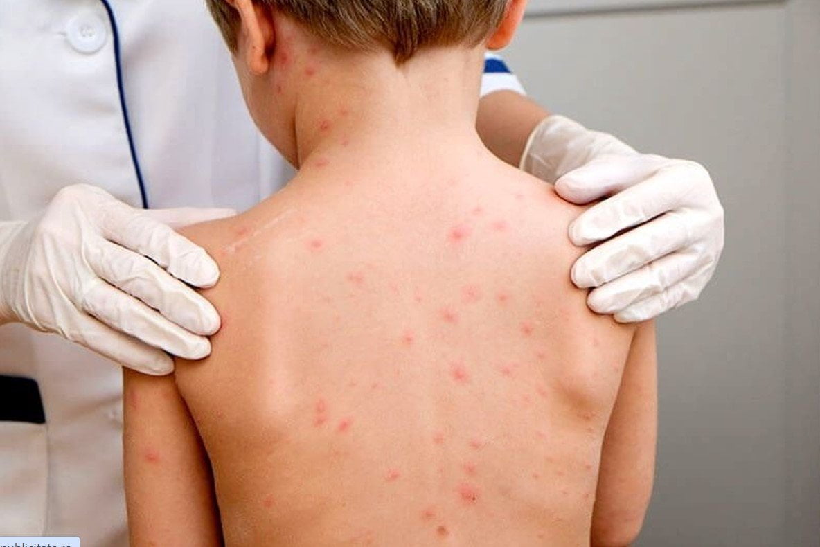 Vladimir Bolocan:„17 cazuri de rujeolă în Capitală. Singura modalitate de prevenire a bolii este vaccinarea”
